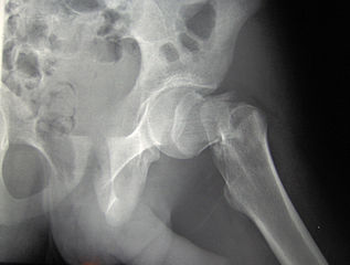 317px-cdm_hip_fracture_343